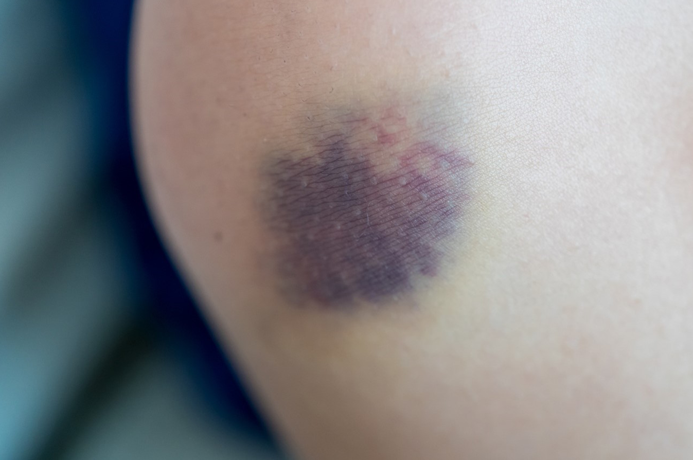 成長板骨折の危険因子は何ですか?